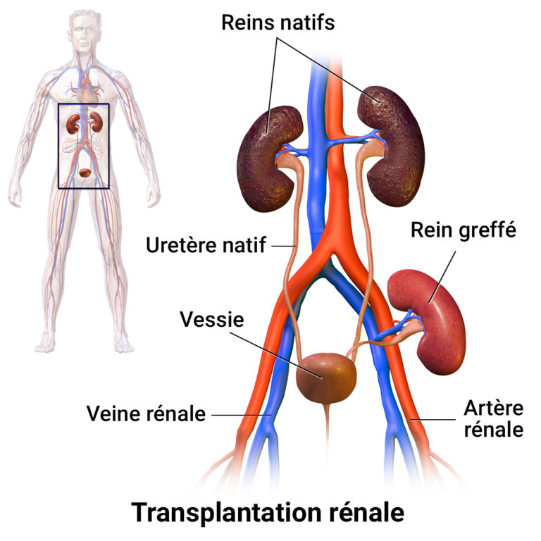 La greffe rénale comment se déroule la transplantation