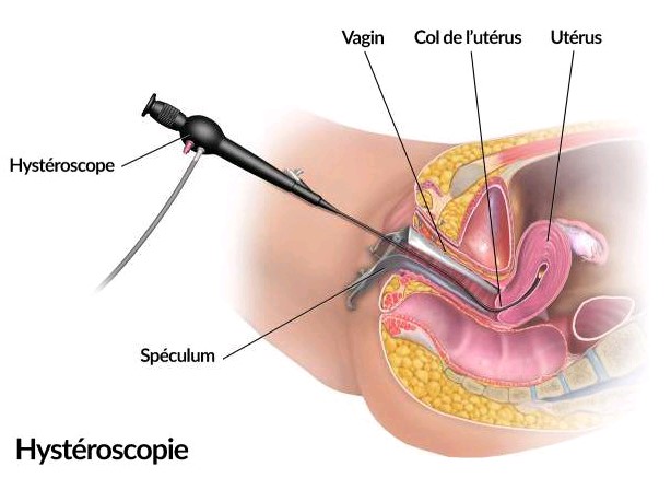 L’hystéroscope rentre dans le vagin écarté par le spéculum, jusqu’à l’utérus en passant par le col de l’utérus.