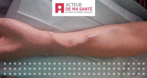 Hmodialyse: Richtige Umgang mit dem Dialyseshunt