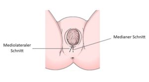 Bei einem Dammschnitt werden ein medio-lateraler und ein medialer Schnitt zwischen Vagina und Anus gemacht.