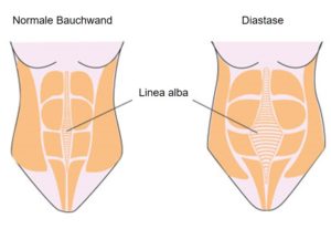 Die weiße Linie der Bauchwand ist bei einer Diastase normaler