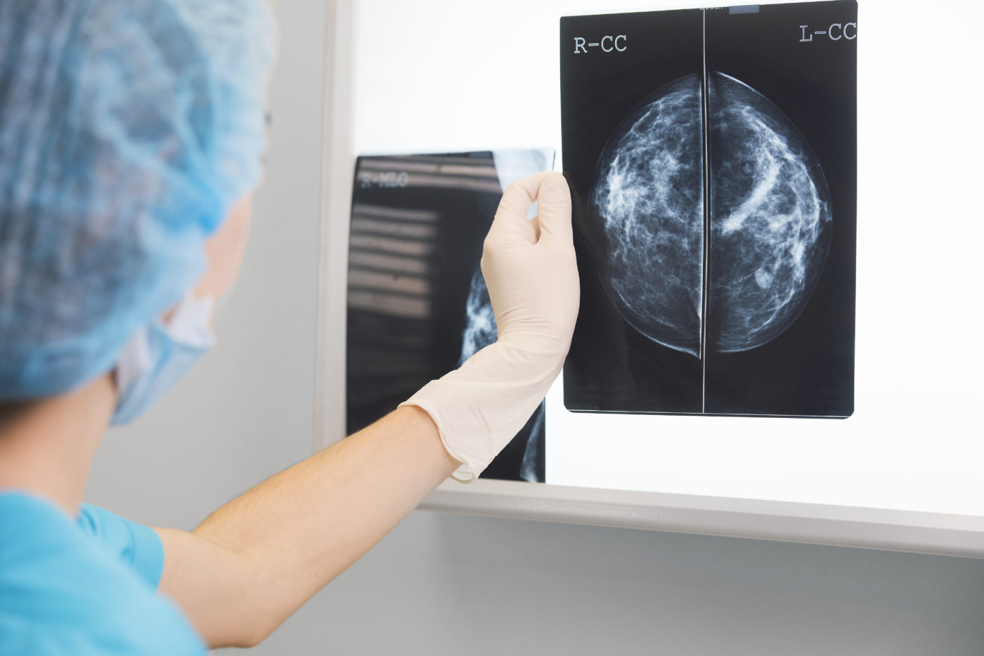 Les traitements du cancer du sein : la chirurgie conservatrice
