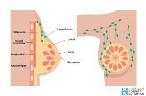 Die Axilladissektion oder axilläre Lymphknotendissektion (Lymphknotenausräumung) ist ein chirurgischer Eingriff, der in der Entfernung eines Teils der axillären Lymphknoten auf der Tumorseite besteht.