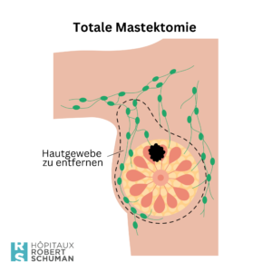 Die totale Mastektomie: Sie besteht in der Entfernung der Brust einschließlich Hautmantel und Brustwarze.