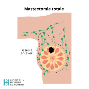 La mastectomie totale : elle consiste à retirer le sein, enveloppe cutanée et mamelon.