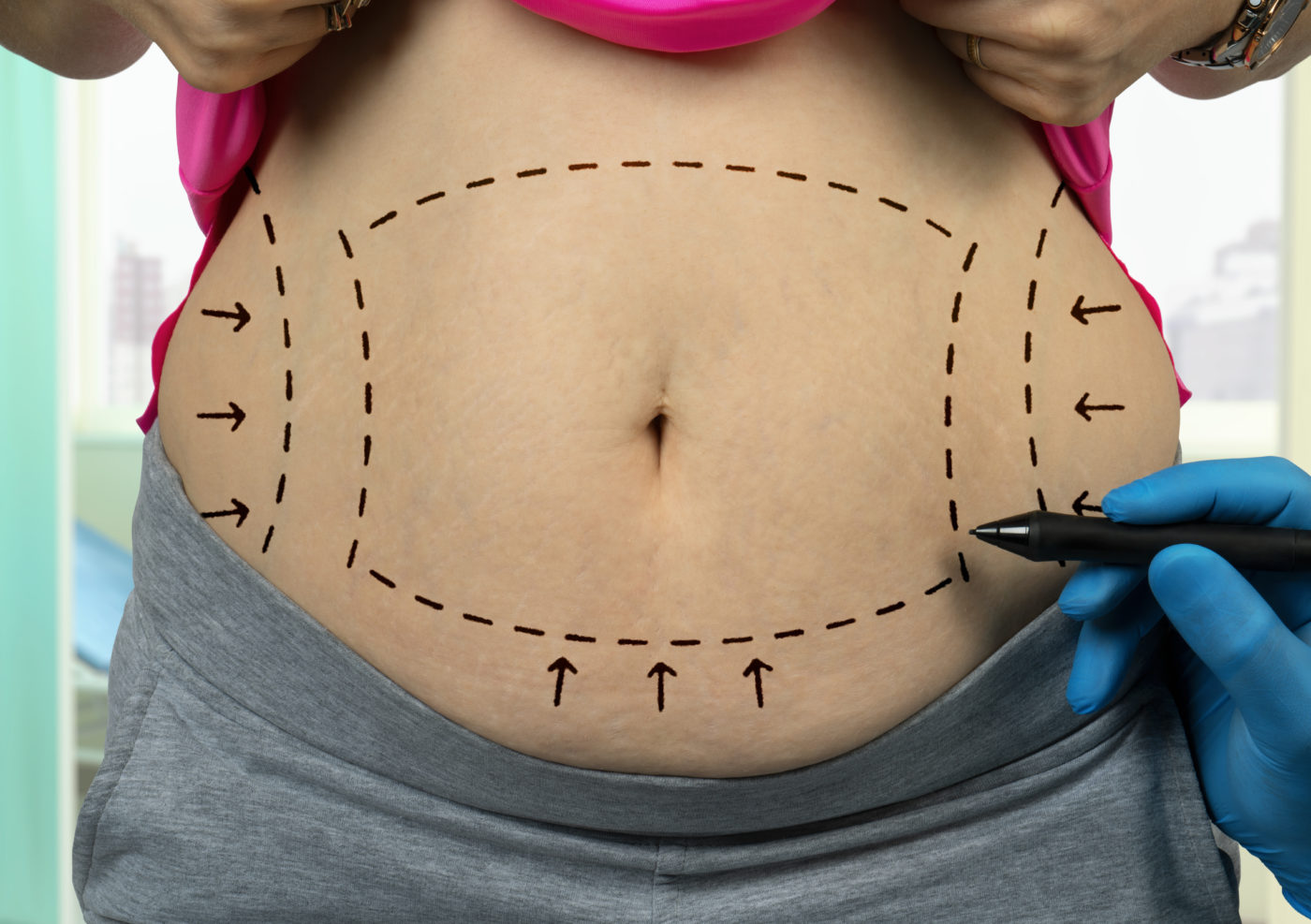 Graisse abdominale : qu'est-ce que c'est et comment l'éliminer ?