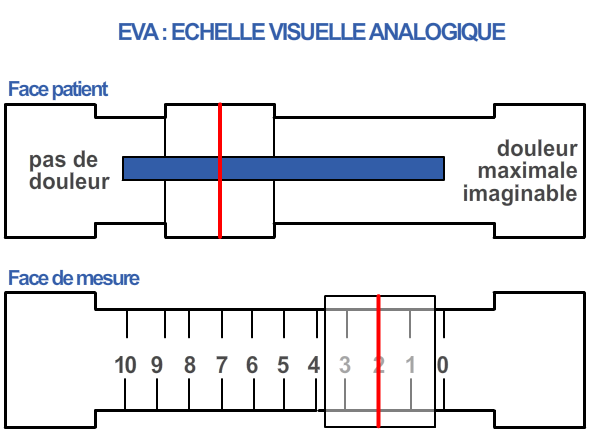 L'échelle EVA (Echelle visuelle analogique) est utilisée pour évaluer la douleur du patient.