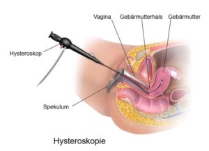 Mithilfe eines Spekulums wird das Hysteroskop in die Vagina eingeführt. Durch den Gebärmutterhals dringt es bis zur Gebärmutter vor. 