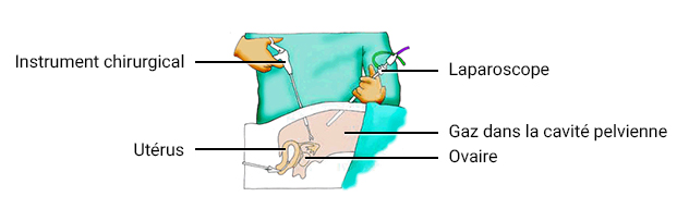 Un gaz est inséré dans la cavité pelvienne et le chirurgien opère avec un instrument chirurgical et un laparoscope dans l'utérus.
