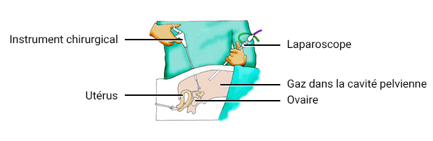 La Coelioscopie Tout Savoir Sur Cette Chirurgie Mini invasive La Coelioscopie Tout Savoir Sur Cette Chirurgie Mini invasive
