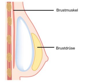 Der Einsatz der Implantate durch den plastischen Chirurgen erfolgt subglandulär: Die Implantate werden direkt hinter der Brustdrüse, d. h. vor den Brustmuskeln platziert.