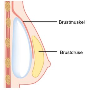 Der Einsatz der Implantate durch den plastischen Chirurgen erfolgt nach der Dual-Plane-Technik (Doppellagentechnik): Der obere Teil des Implantats wird hinter dem Brustmuskel positioniert, und der untere Teil unabhängig vom Brustmuskel hinter der Brustdrüse.