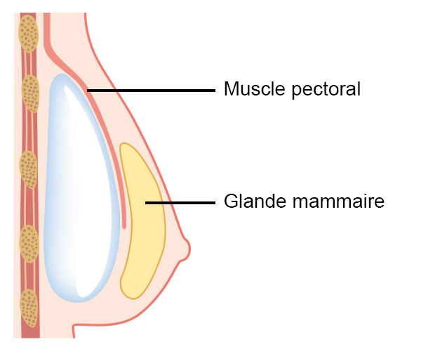 Le chirurgien plasticien insère les prothèses. soit en dual plan : les prothèses sont placées pour partie derrière le muscle pectoral et pour partie derrière la glande détachée du muscle dans sa portion inférieure.