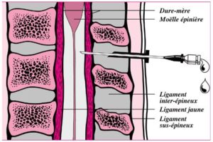 Das Rückenmark wird von der Dura Mater umhüllt. Die Punktion erfolgt auf der Höhe des mit Flüssigkeit gefüllten Liquorraumes, der das Rückenmark umgibt. Dabei durchdringt die Injektionsnadel die Ligamenta interspinalia und das Ligamentum supraspinale.
