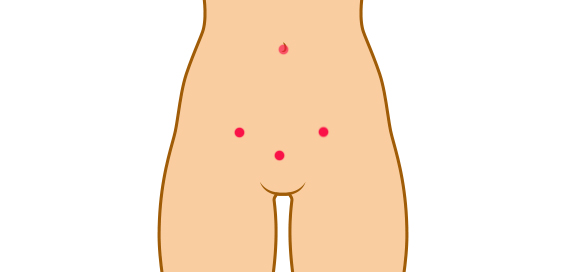 2 à 3 incisions en sus pubien (de 5 mm) ainsi qu’au niveau du nombril, sont réalisées.