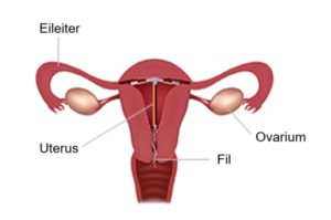 Schema, das den Gebärmutterhals und die Position der Spirale in der Gebärmutter zeigt.