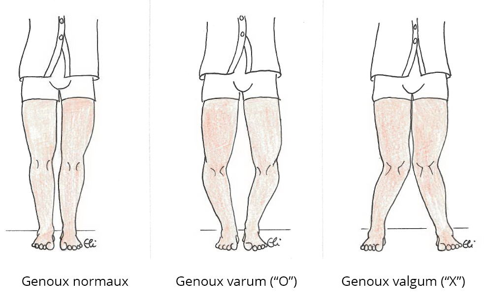 Prothèse du genou : les maladies du genou |