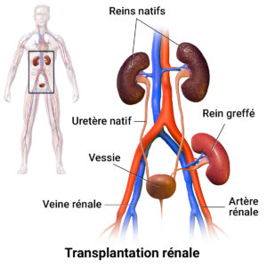 HopitalKirchberg_Transplantation_Renale