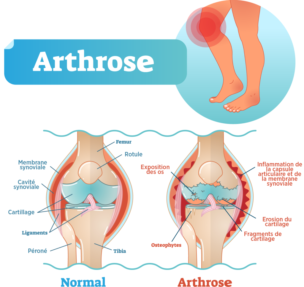 Pourquoi Le Cartilage Interm diaire S Use T Il En Cas D Arthrose Des pourquoi-le-cartilage-interm-diaire-s-use-t-il-en-cas-d-arthrose-des