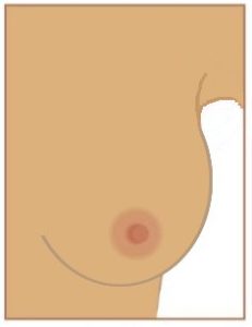 Sensation de nodule ou épaississement d’un sein