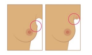 ein anhaltender Knoten oder eine Schwellung in der Brust oder in der Achselhöhle
