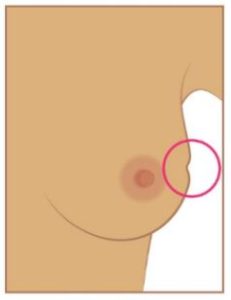 Apparition d’un creux à la surface du sein