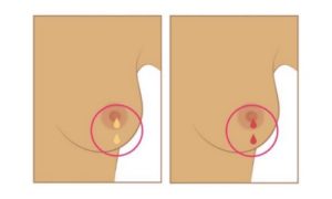 Rétraction de la peau (comme une peau d’orange) ou écoulement du mamelon