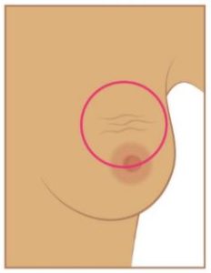 Changement de l’aspect de la peau du sein (rougeur inhabituelle, chaleur, épaississement ou durcissement, changement de la peau autour du mamelon)