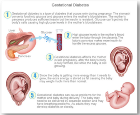 Le diabète gestationnel