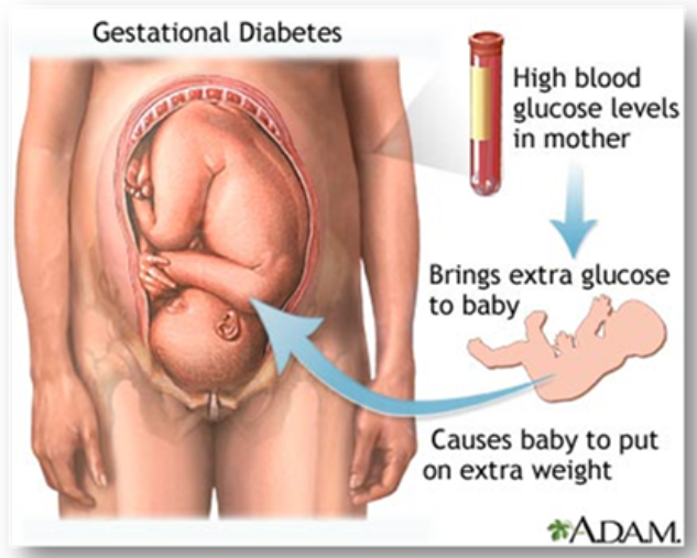 Le Diabete Gestationnel