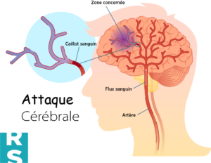 Il correspond à la mort des cellules nerveuses du cerveau, privées de sang, donc d’oxygène, du fait de l’occlusion d’une artère, qui survient toujours à partir d’une plaque d’athérome* plus ou moins sténosée.