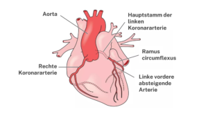 Aus der Aorta entspringen die rechte Koronararterie (unterer Teil), der Ramus interventricularis anterior (unterer Teil), der Ramus circumflexus und die linke Koronararterie.  