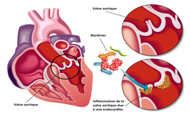 Endocardite : quand la végétation menace le cœur !