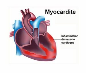 Une myocardite se traduit par une inflammation du muscle cardiaque.
