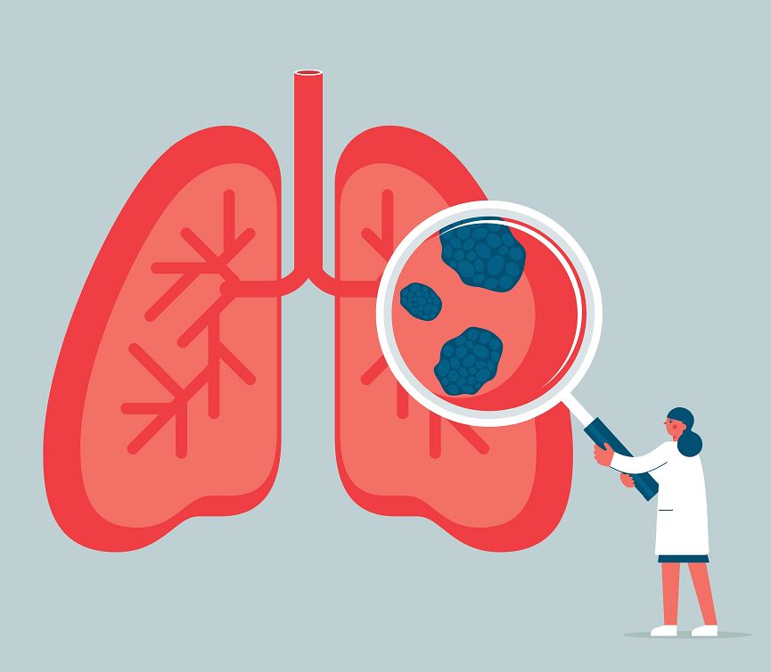 Illustration d’un médecin tenant une loupe devant des poumons rouges révélant des masses sombres représentant des cellules cancéreuses